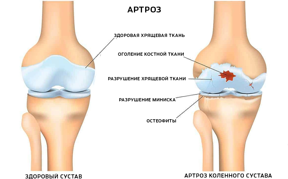 Артроз коленного сустава