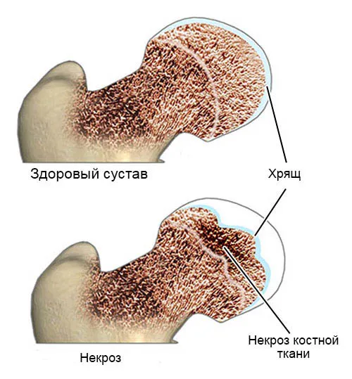 Изменение костей при некрозе