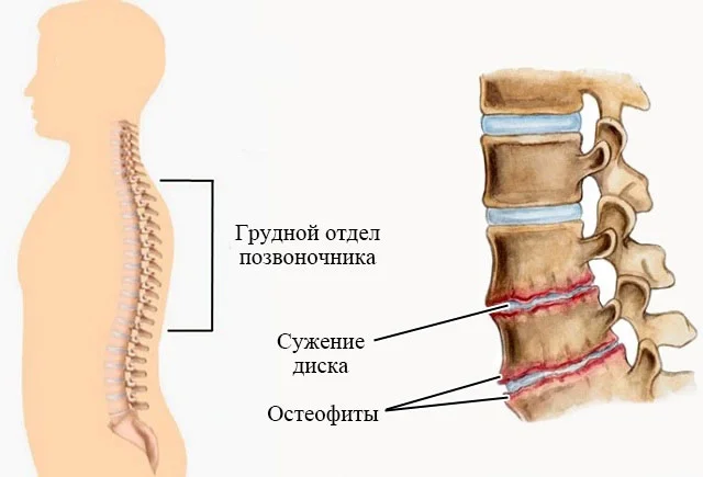 Как выглядят позвонки при остеохондрозе