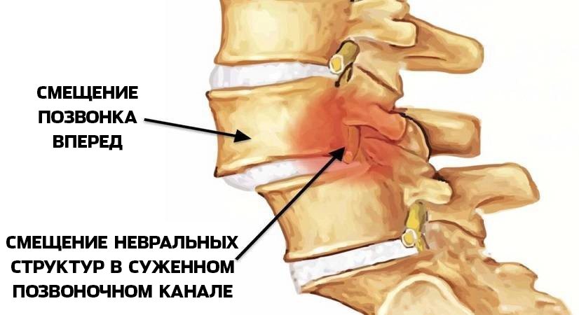 Нестабильность шейного отдела