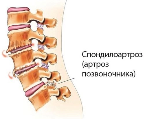 Спондилоартроз