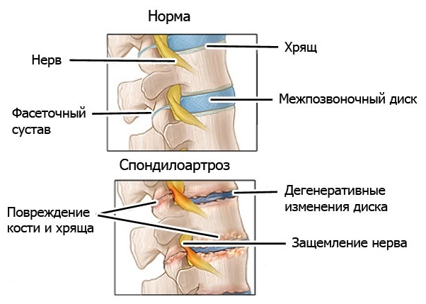 Спондилоартроз крестцового отдела