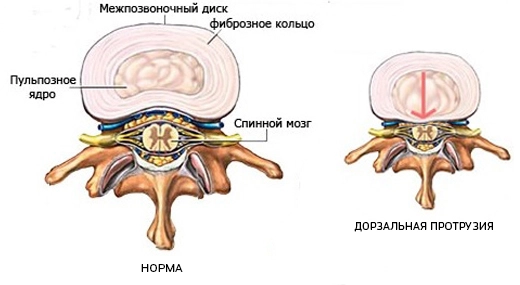 Протрузия поясничного отдела