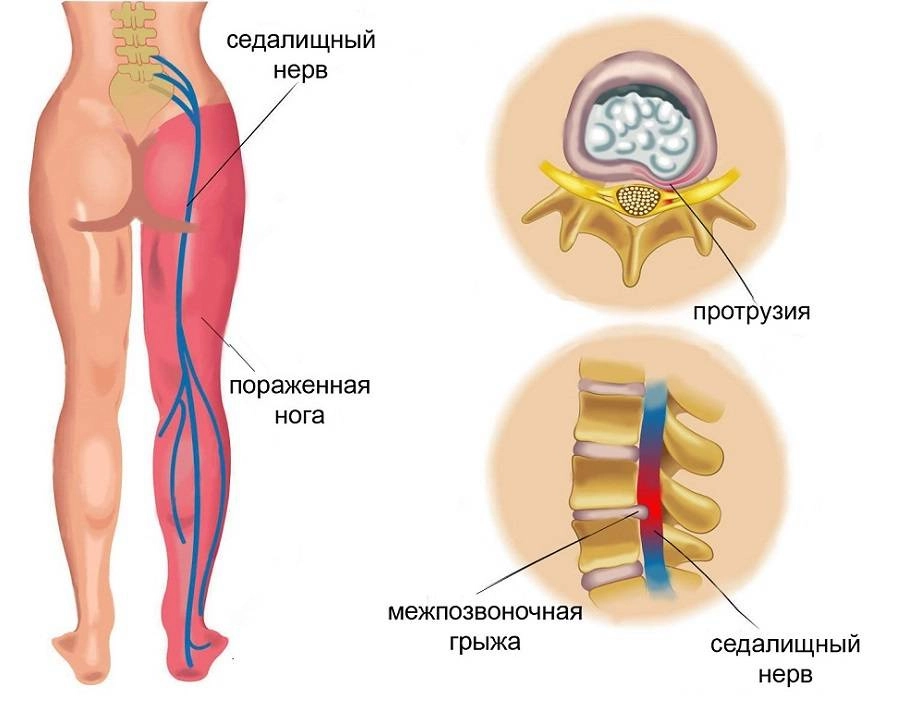 Патогенез защемления седалищного нерва
